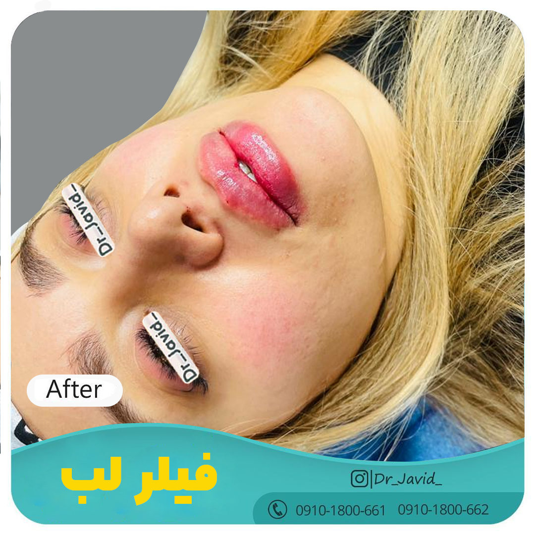 تزریق فیلر لب